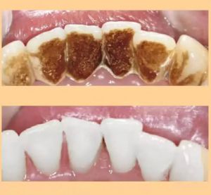 Писалка за избелване на зъби Oralhoe , гел за избелване на зъби, избелващ гел, премахва петна, хигиена на устната кухина
