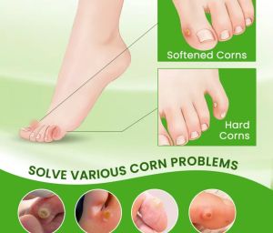 Corns  Sumifun Крем за премахване на мазоли, крем за кожни инфекции от мазоли, мехлем за лечение на мазоли и кокоши трън, инструмент за премахване на мъртва кожа, здравни грижи 1 брой
